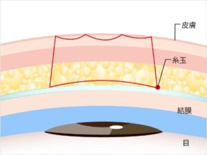 二重整形 tcb1 線留め1本 シークレット