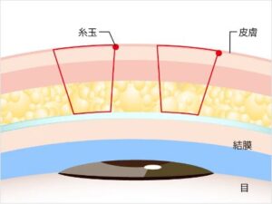 二重整形 tcb 瞼板法
