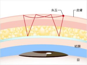二重整形 tcb線留め1本