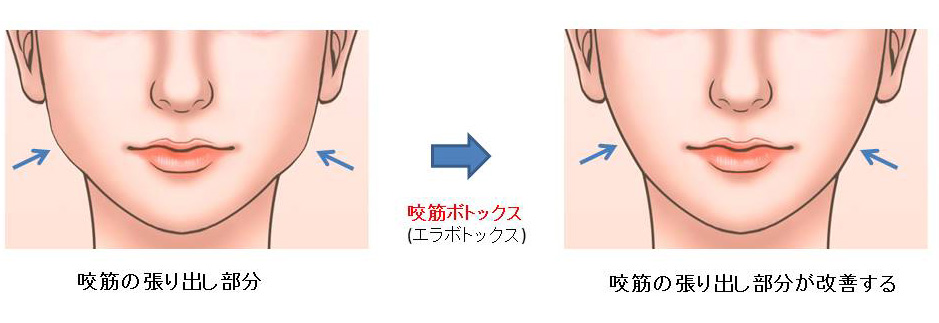 エラボトックス1