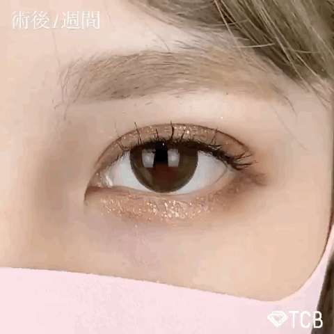 二重整形 埋没法 tcb