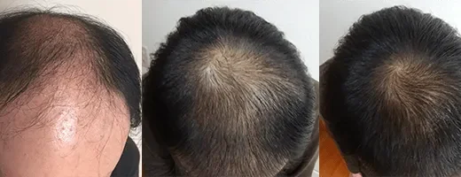 AGAヘアクリニックの症例画像