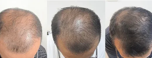 AGAヘアクリニックの症例画像