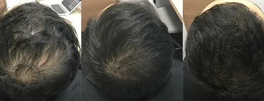 AGAヘアクリニックの症例画像