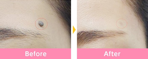 品川美容外科 ほくろ除去の症例画像