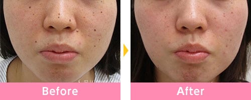 品川美容外科 ほくろ除去の症例画像