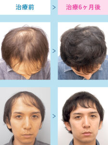 AGAスキンクリニックの症例画像