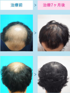AGAスキンクリニックの症例画像
