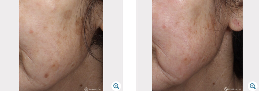 聖心美容クリニックの症例画像