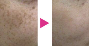 銀座エルクリニックの症例画像