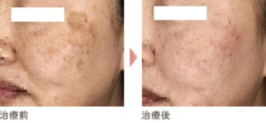 白石ガーデンプレイス皮膚科クリニックの症例画像