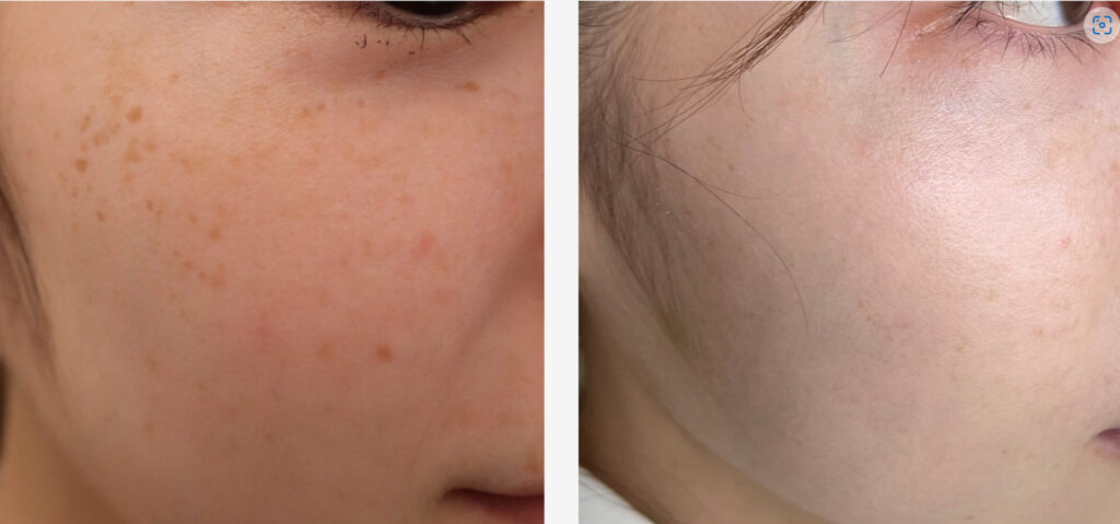 はなふさ皮膚科の症例画像