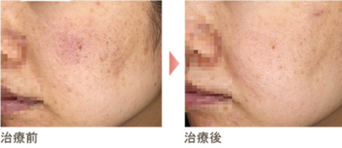 白石ガーデンプレイス皮膚科クリニックの症例写真の紹介画像