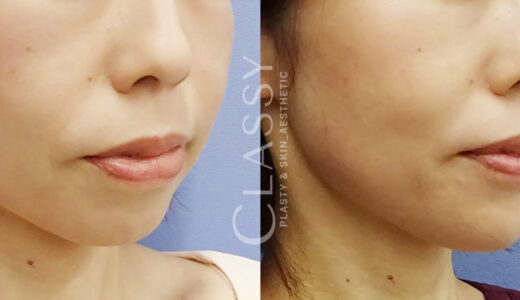 CLASSY 仙台美容外科・美容皮膚科の症例画像