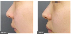 症例画像:ヒアルロン酸