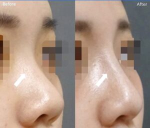 症例写真：プロテーゼ