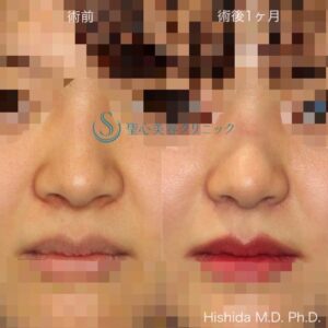 聖心美容症例2