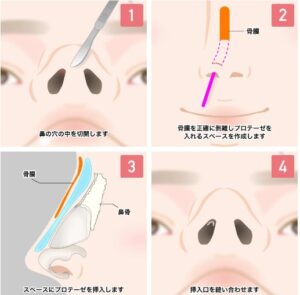 解説画像:プロテーゼ