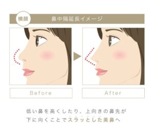 鼻中隔延長術解説