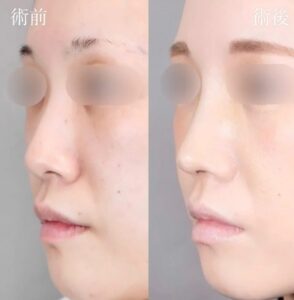 症例写真:鼻尖形成