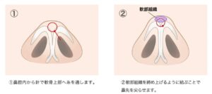 鼻尖形成解説画像
