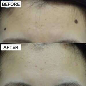 症例：レーザー治療TCB東京美容外科