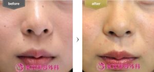 東京美容外科症例②